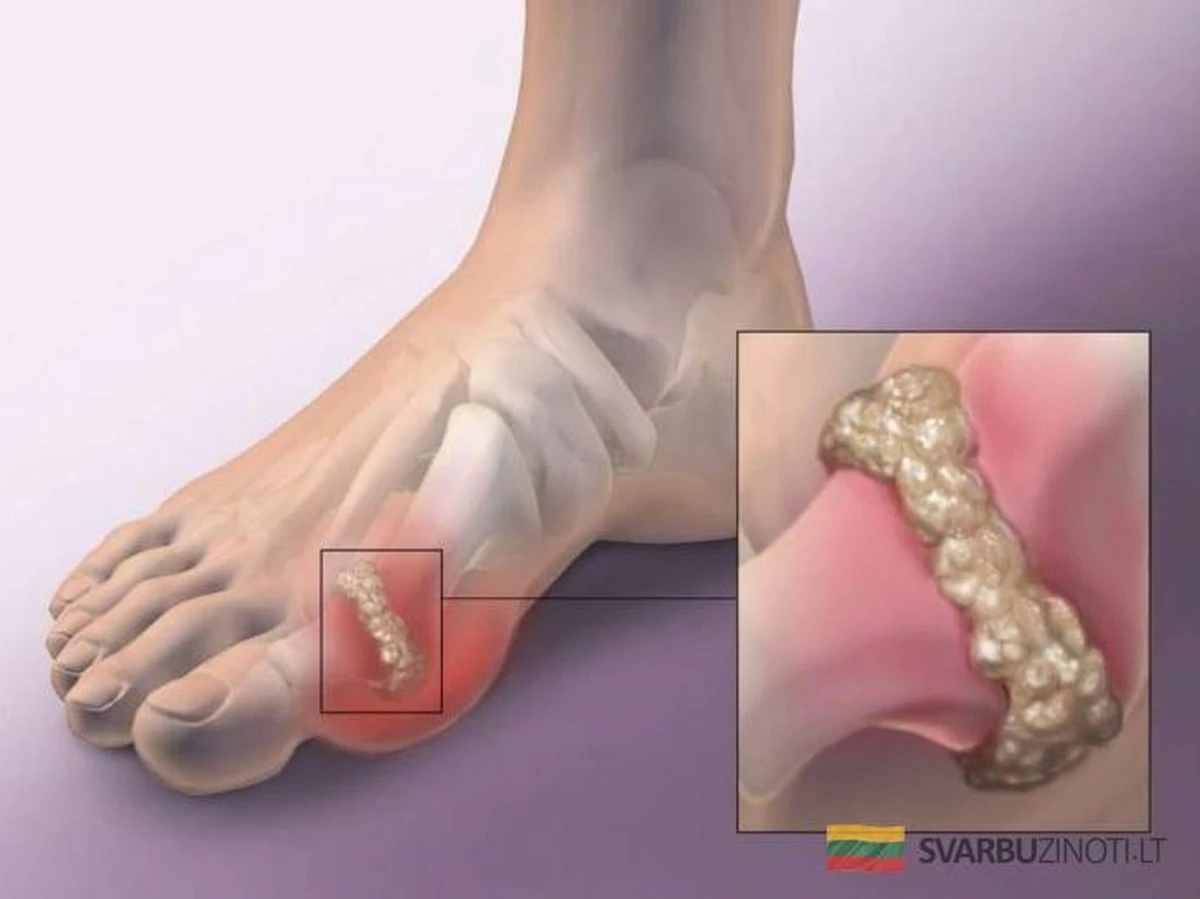 Jugo casero que depura tu cuerpo de ácido úrico en días