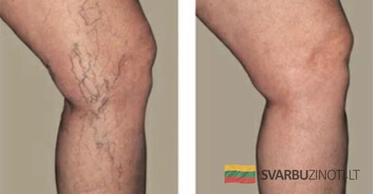 5 hábitos que detienen las venas varicosas antes de que aparezcan