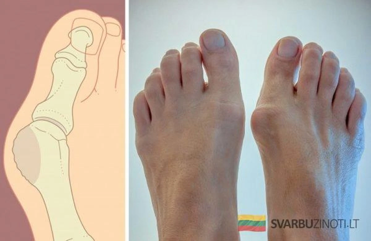 el hueso del pie: qué necesitas saber sobre los juanetes antes de probar remedios caseros